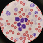 Bazofilai: Kodėl šie kraujo „mažyliai“ sukelia audras jūsų organizme?